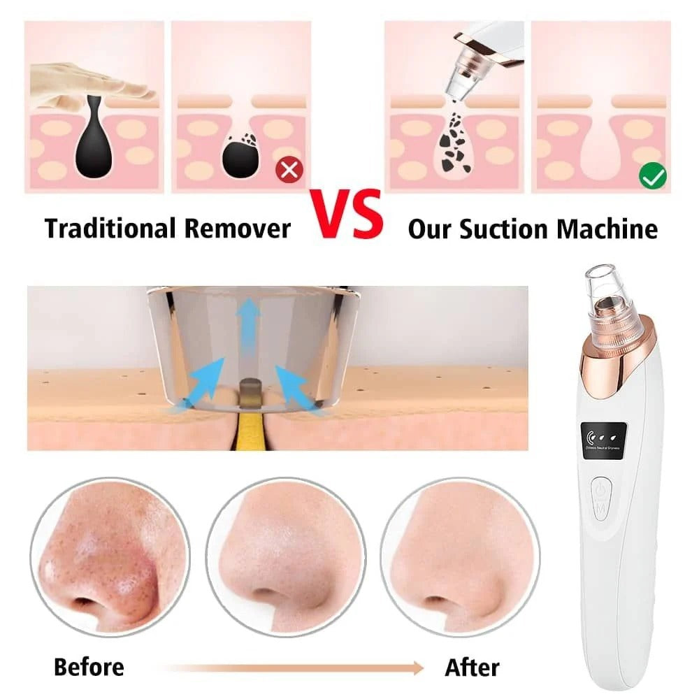 Electric Blackhead Remover | Vacuum Acne & Pore Cleaner
